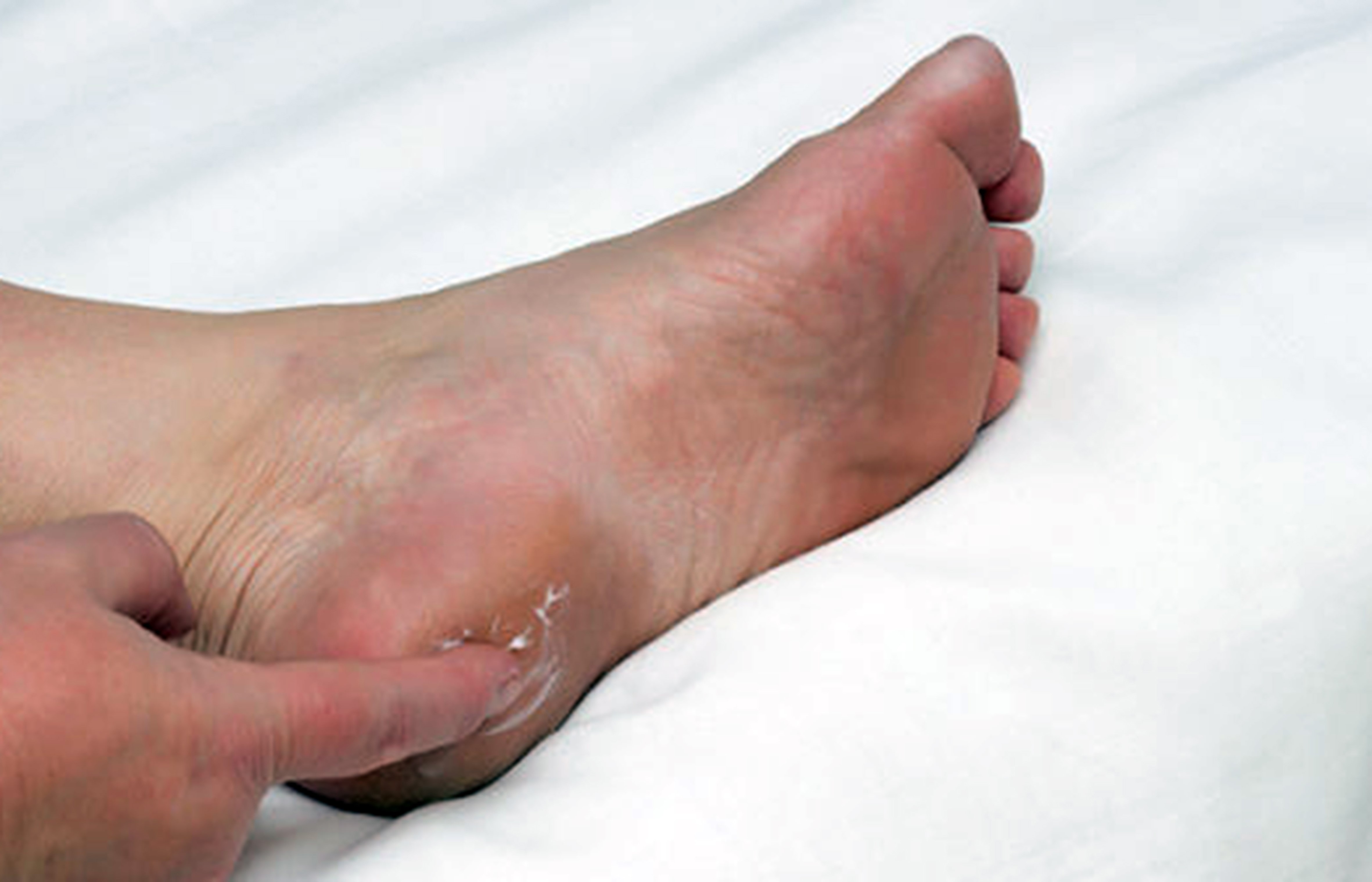 Prof. Dr. Karalezli’den Topuk Dikeni Uyarısı (2)