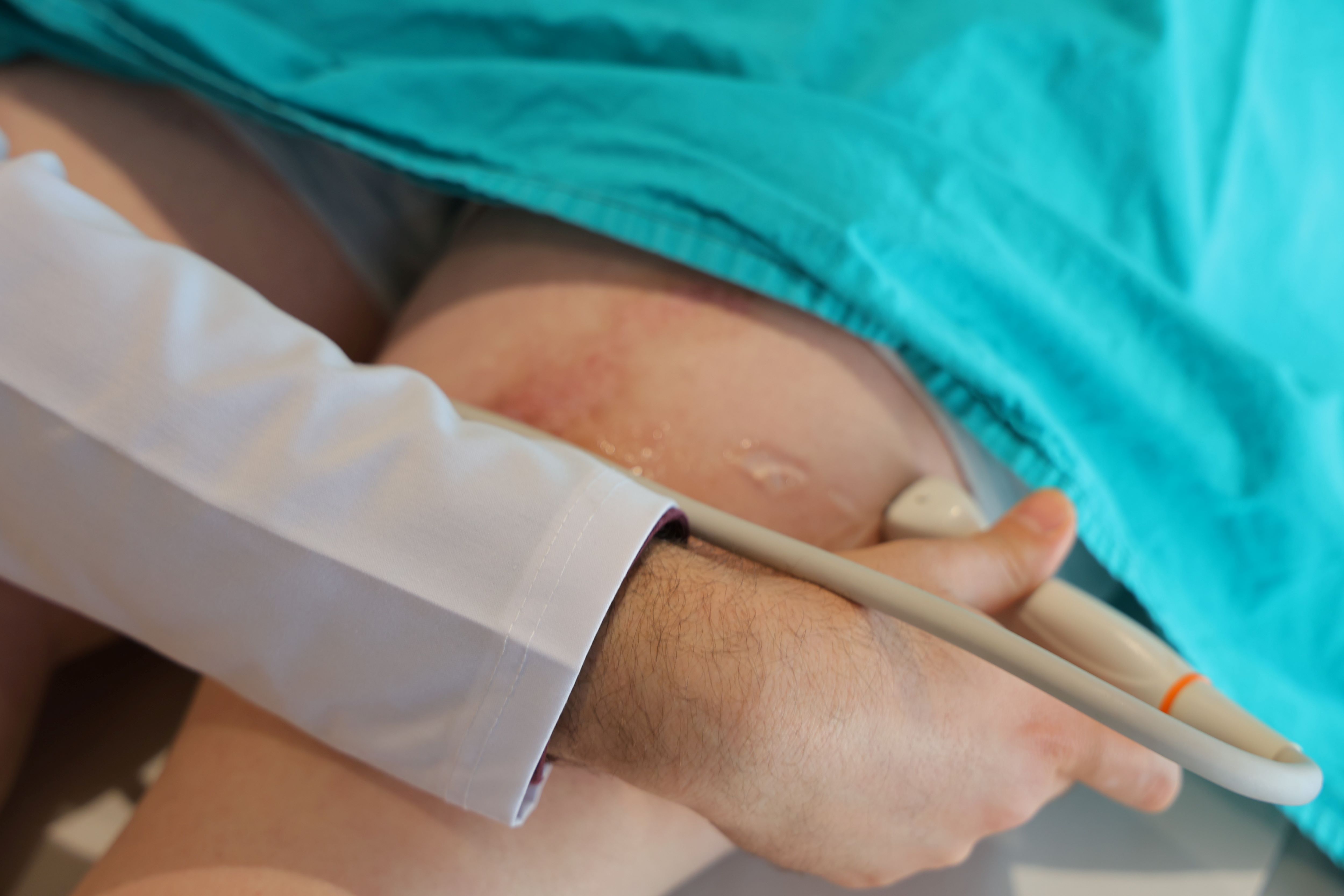 Tekerlekli Sandalyeyle Geldi, Hastaneden Yürüyerek Çıktı (4)