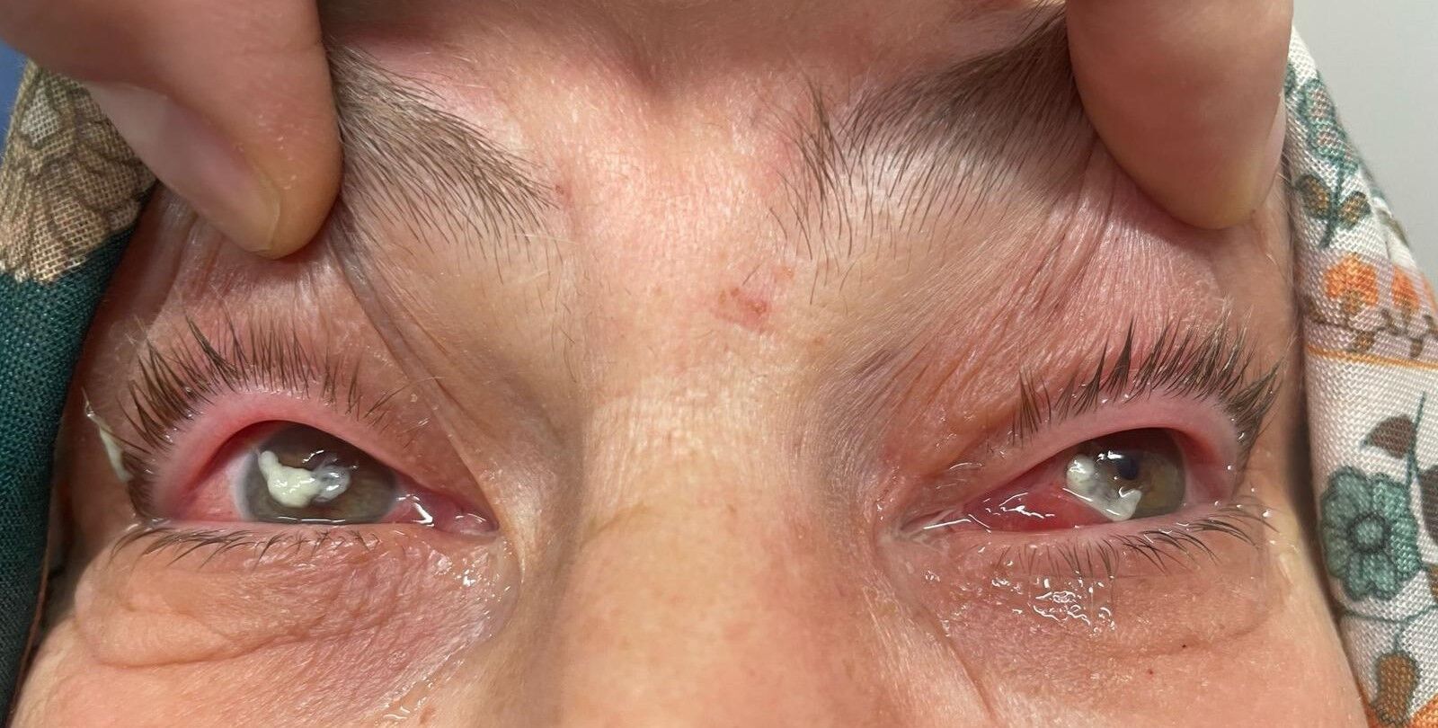 Göz Sağlığında Tehlikeli Trend Kırlangıç Otu Uyarısı (4)