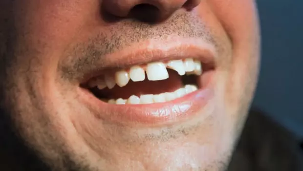 Rüyada Diş Görmek Ne Anlama Gelir (1)